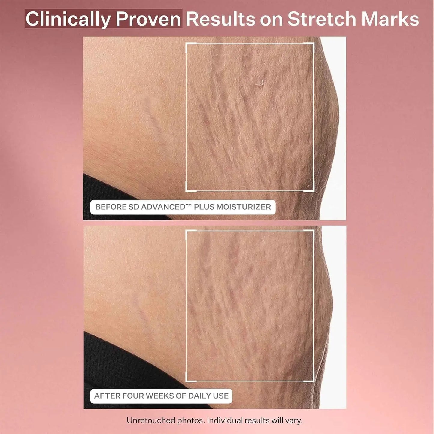 SD Advanced™ plus Intensive Moisturizer for Wrinkles & Stretchmarks, for Face & Body, Collagen Boosting with Peptides & Hyaluronic Acid